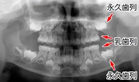 5才児の乳歯から永久歯へ、交換過程のレントゲン像