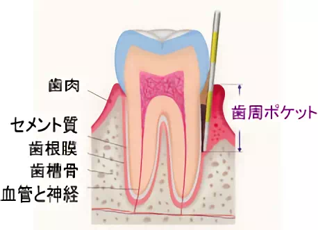 歯周病ポケット検査の画像